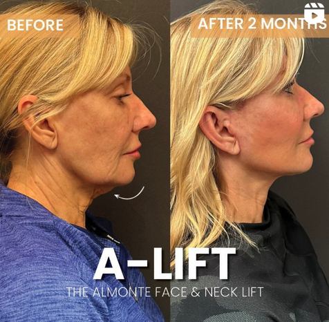 Facial Plastic Surgery and How It Benefits You